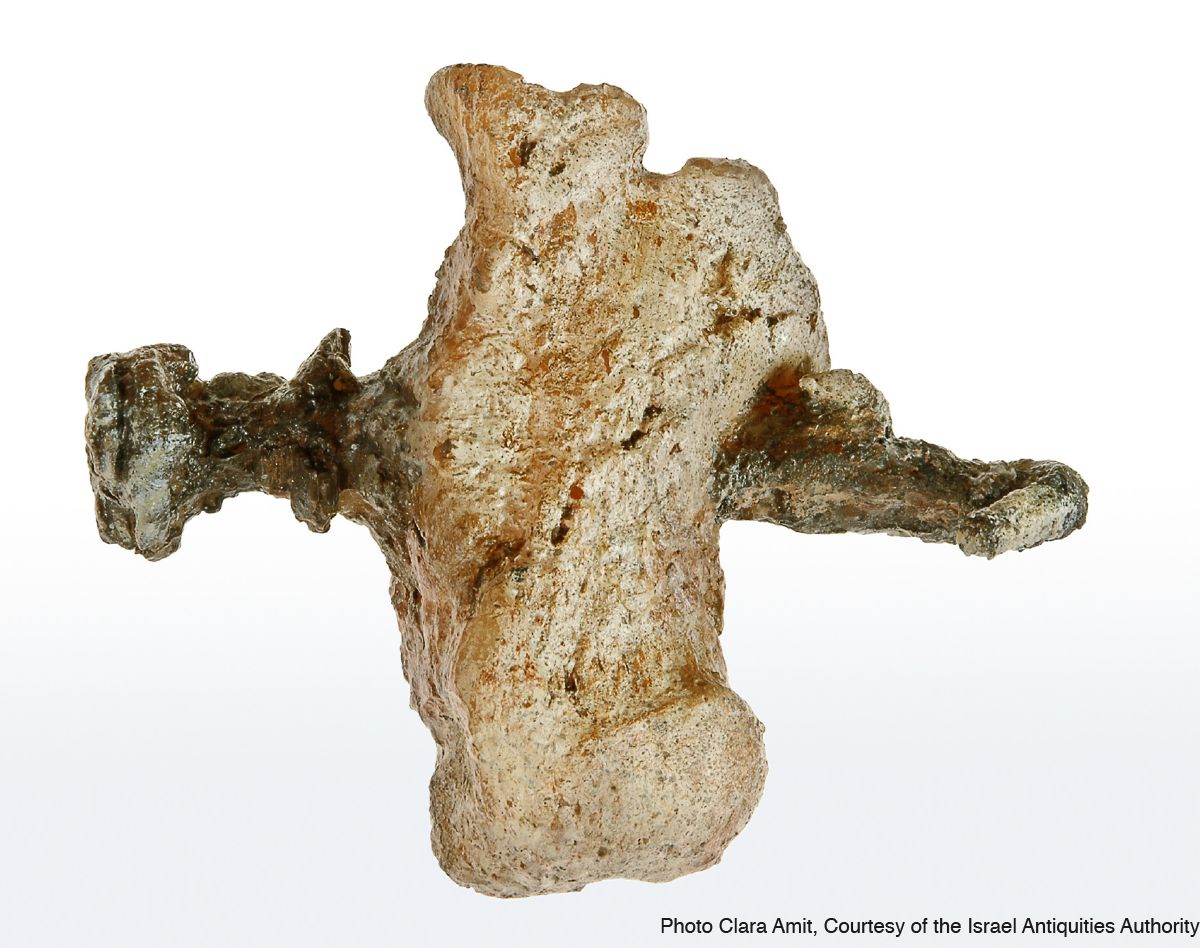 Hueso del talón atravesado por un clavo